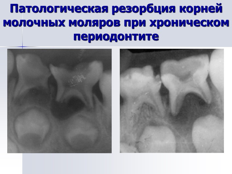 Патологическая резорбция корней молочных моляров при хроническом периодонтите